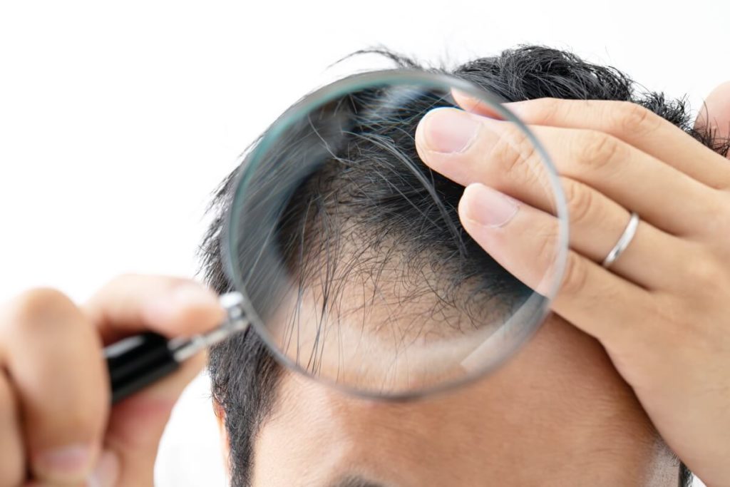 虫眼鏡で頭皮を確認する男性