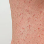 脱毛に伴う炎症や埋没毛の処理の仕方。