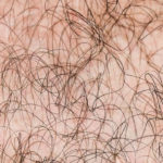 永久脱毛って？濃い体毛のお悩みとおさらば