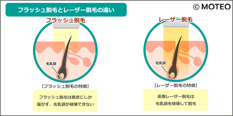 医療レーザー脱毛とフラッシュ脱毛の違い