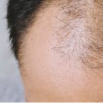 M字ハゲは改善できる?