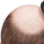 O字ハゲの原因と対策方法は?