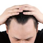 U字ハゲの原因と対策方法は?