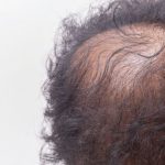 薄毛対策で抜け毛を改善できる?
