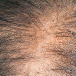 ハゲの原因のウソ本当!男性ホルモンが薄毛の関係にあり?