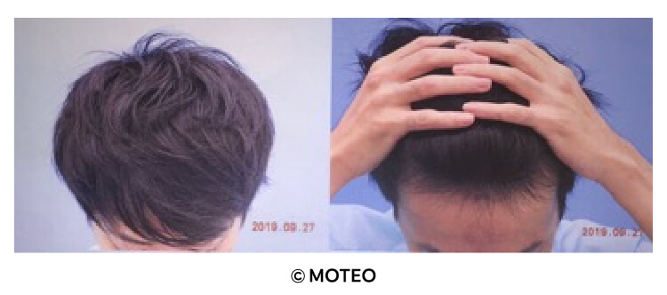 DクリニックでのAGA治療半年後の頭髪と生え際の写真