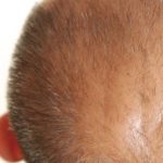 植毛に向いてる人って?