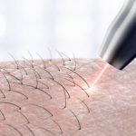 ヤグレーザーの脱毛効果は？