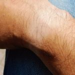 【メンズ】腕毛脱毛おすすめ人気ランキング