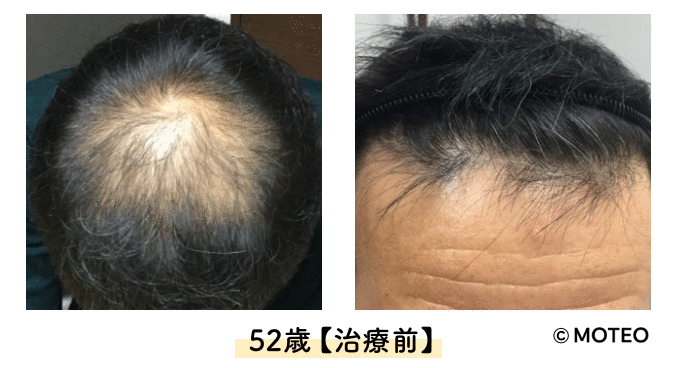 新宿AGAメディカルケアクリニック AGA治療経過 生え際と頭頂部