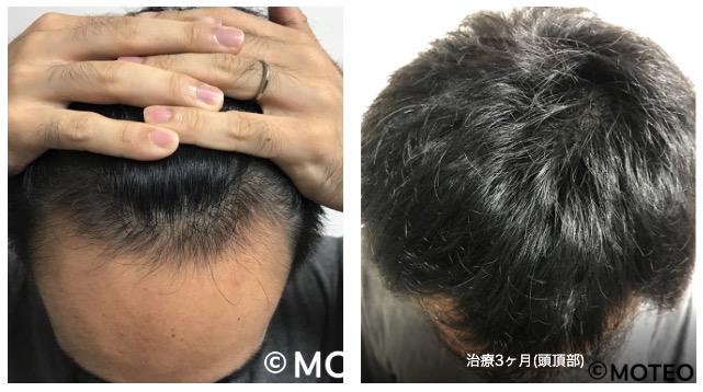 写真と経過 Aga治療の効果を1ヶ月目 2ヶ月目 3ヶ月目 と1年間に渡り記録 M字ハゲでも薄毛は改善するのか Moteo