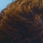 頭頂部・つむじの植毛が失敗することはある?