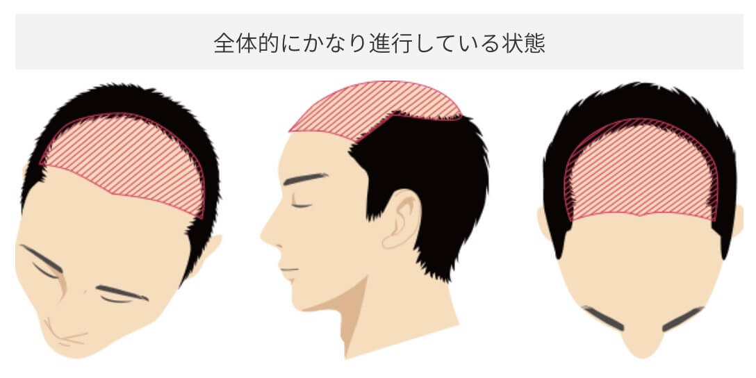 前頭部・頭頂部への施術