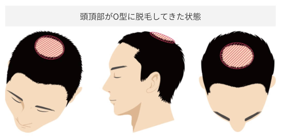 頭頂部・つむじへの施術
