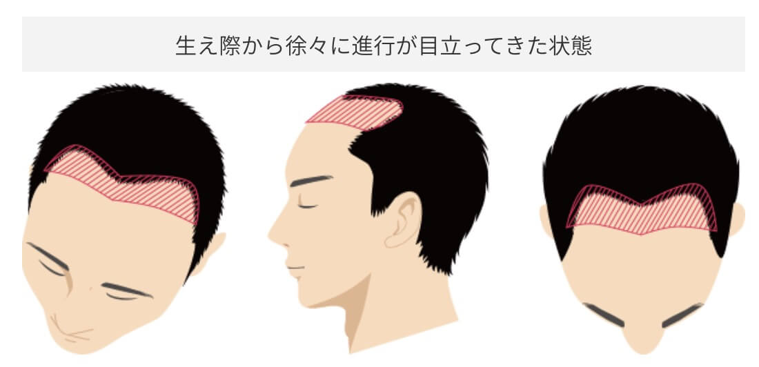 M字への施術