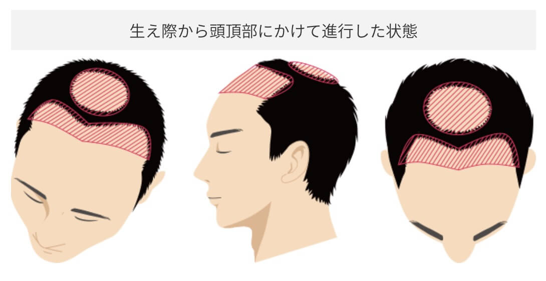 前頭部への施術