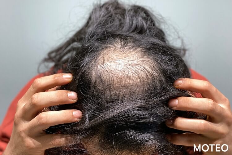 O字ハゲは改善できる 頭頂部 つむじ の薄毛の原因と対策 おすすめの髪型などを紹介 Moteo