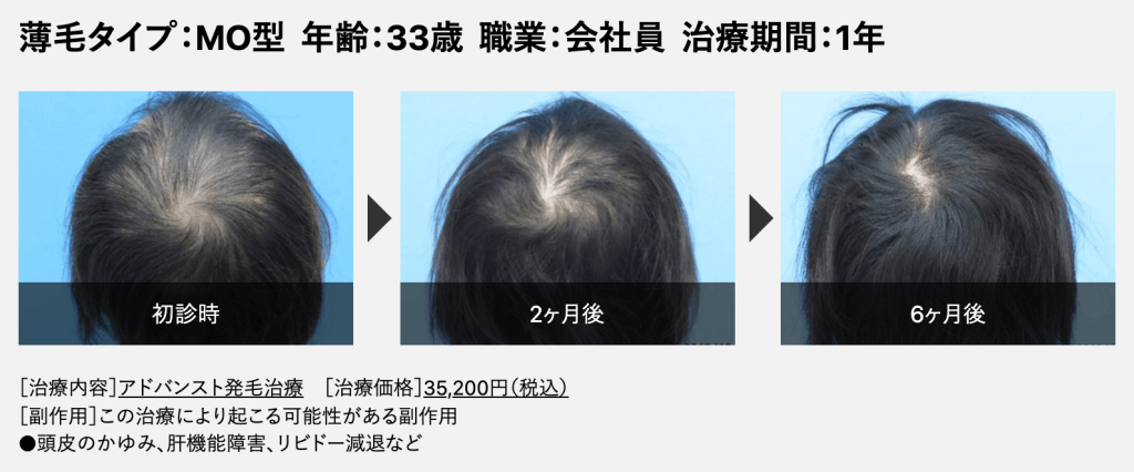 Dクリニック 症例 33歳MOタイプの薄毛の頭頂部 ビフォーアフター