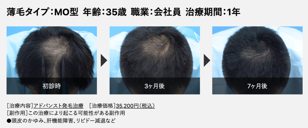 Dクリニック 症例 35歳MOタイプの薄毛の頭頂部 ビフォーアフター