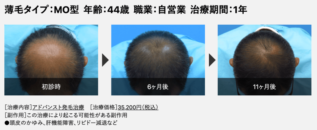 Dクリニック 症例 44歳MOタイプの薄毛の頭頂部 ビフォーアフター
