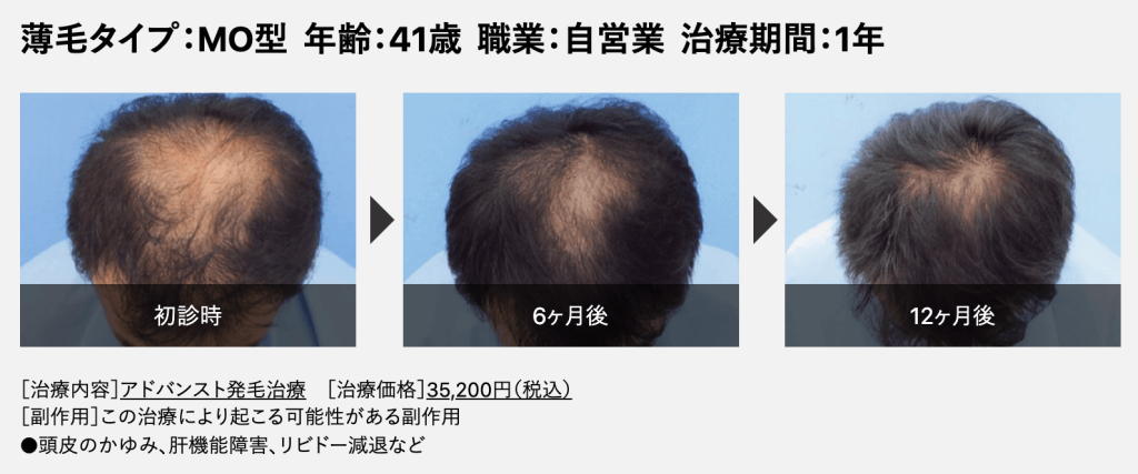 Dクリニック 症例 41歳MOタイプの薄毛の頭頂部 ビフォーアフター
