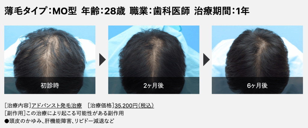 Dクリニック 症例 28歳MOタイプの薄毛の頭頂部 ビフォーアフター