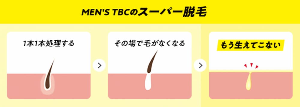 MEN'S TBCのスーパー脱毛