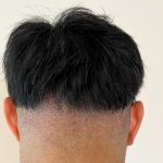 植毛2日後の刈り上げの写真